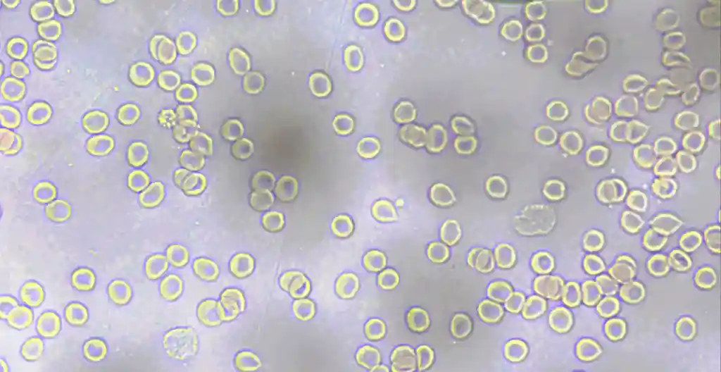 Ein Video von Blutzellen unter dem Mikroskop, das bestimmte Zellen mit Defekten hervorhebt.